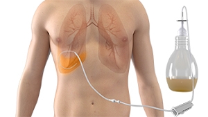 Sinh thiết màng phổi mù