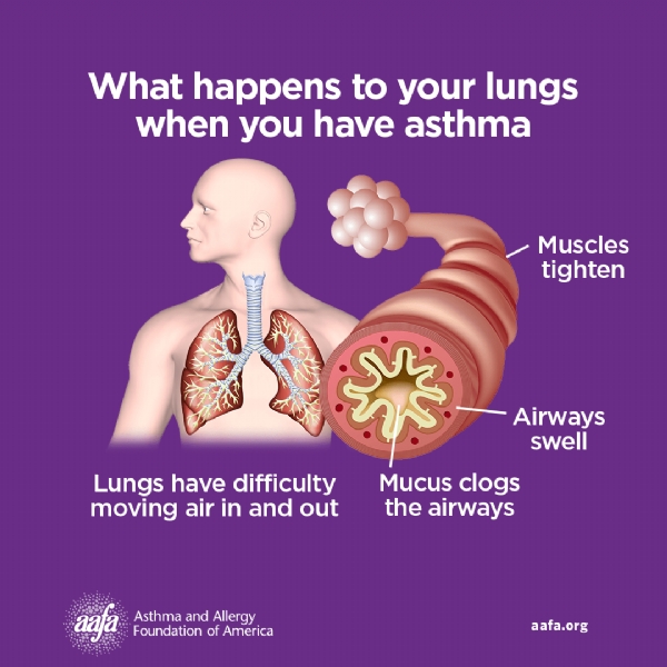 Hen phế quản: phân loại và đánh giá mức độ nặng