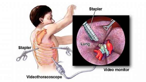 Sinh thiết u trung thất dưới hướng dẫn của siêu âm