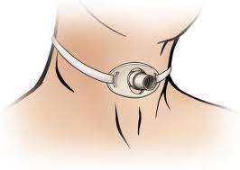 Đặt Catheter qua màng nhẫn giáp lấy bệnh phẩm